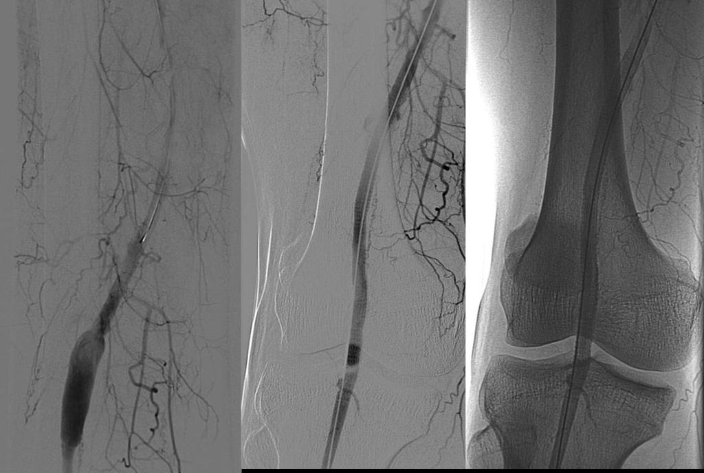 The preliminary angiography confirms this finding: the aneurysm has been successfully treated by Viabahn stent-graft placement.