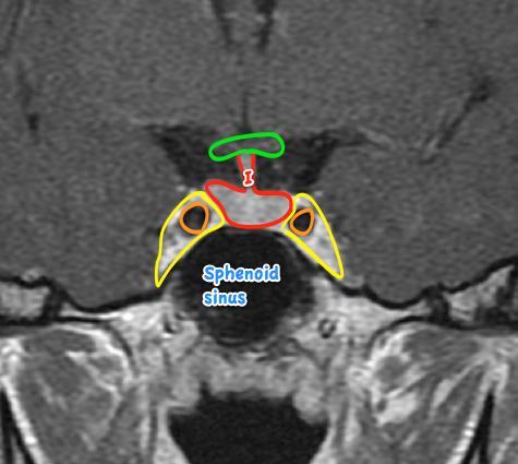 Normal MRI Pituitary First; locate pituitary Between these black holes Internal