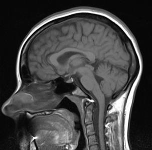 Normal MRI Pituitary Optic nerve