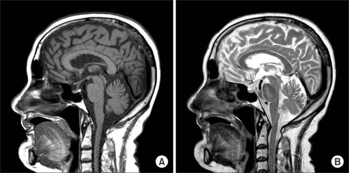 Normal MRI Pituitary