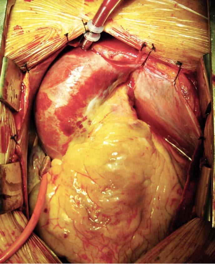 Intraoperative view of the cannulated distal ascending aorta