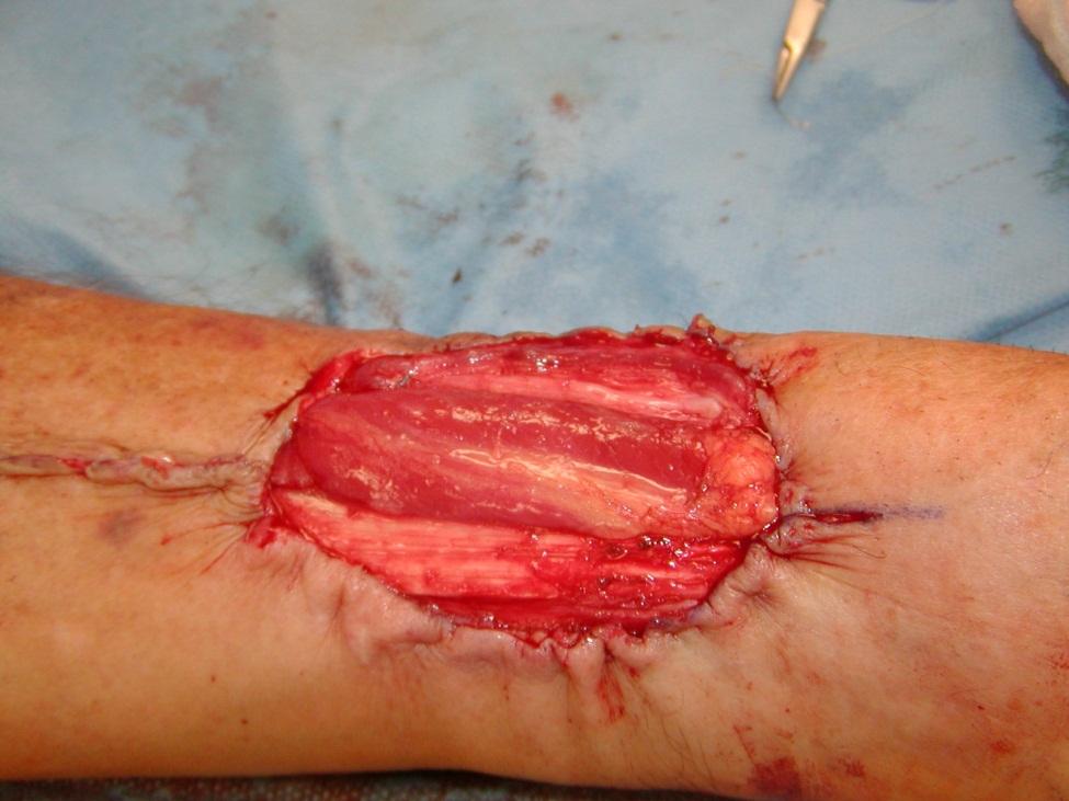 Split thickness skin graft taken from the flap site on the forearm. 2. The skin graft should be preserved in saline while the free flap is harvested.