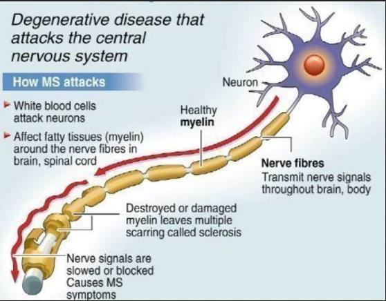 What is Multiple Sclerosis Multiple sclerosis is a chronic, immune-mediated inflammatory demyelinating