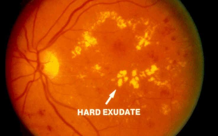 Nonpeoliferative Retinopathy Micro aneurisms Scattered exudates Hemorrhages(flame
