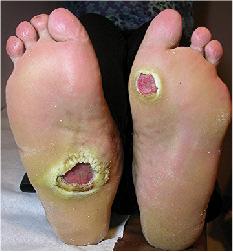 Foot ulcers Prevention always better than