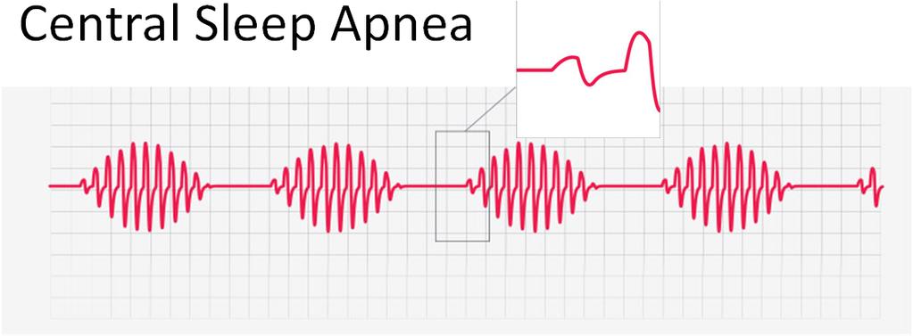 Overview Defining Central Sleep Apnea (CSA) Diagnosing Central Sleep Apnea Deadly Combination of Central Sleep Apnea and Heart Failure Device based therapy: remede system Pivotal Trial Results