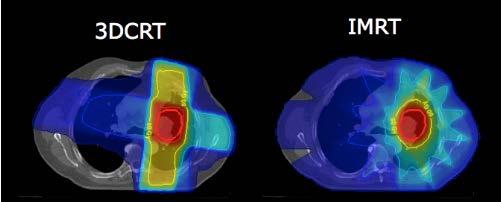 NRG/RTOG 0617 Analysis 3DCRT vs IMRT: Chun et al, JCO 2017 High 60+ Gy Intermediate 20-50 Gy Low 5 Gy Rationale IMRT improves target conformity and reduces both high and
