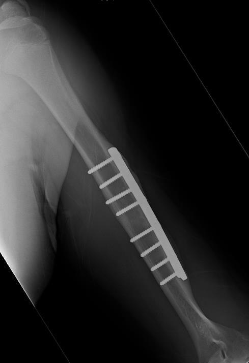 Humeral shaft - Operative Unable to maintain reduction Nerve injuries