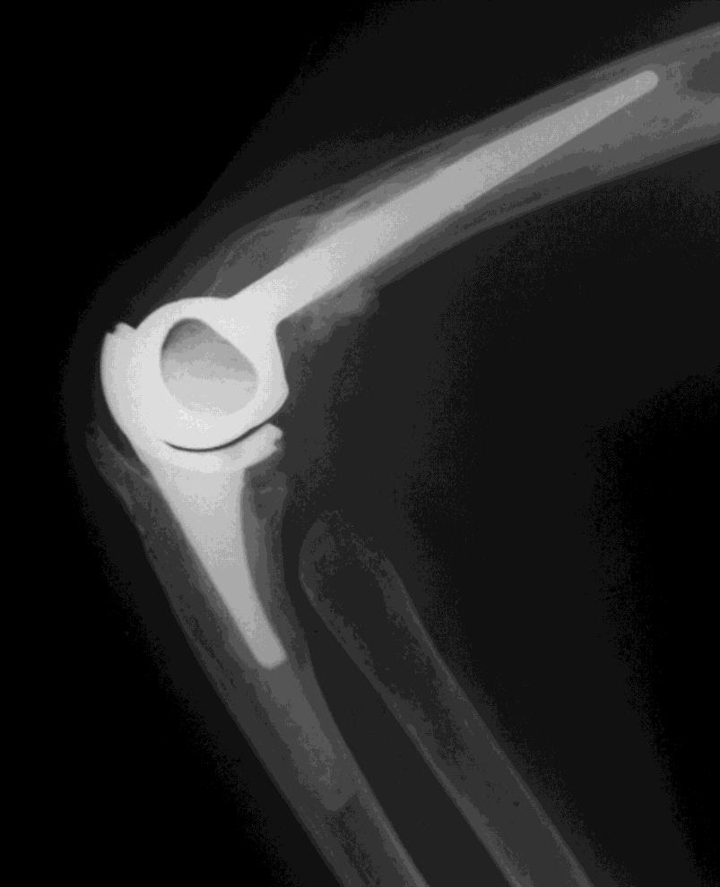 Other Potential Surgical Options Total elbow arthroplasty Comminuted intra-articular fracture in the elderly