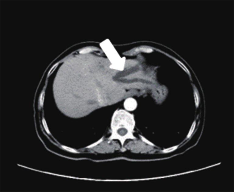 dilation of the bile duct (arrows), both intrahepatic and extrahepatic.