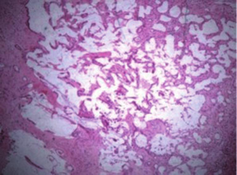 a diagnosis of mucinous cystic neoplasm (MCN), 7 were considered IPMN-B, and one as cholangiocarcinoma.