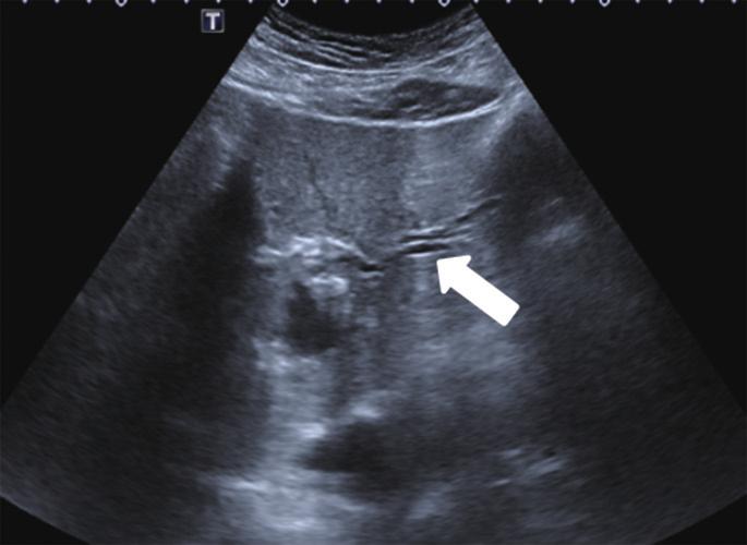 symmetrical diffuse dilation of the bile duct (arrows) in the left liver.