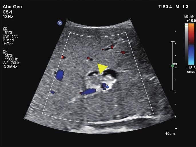 To our knowledge, this study has the largest number of IPMN-B patients who underwent conventional trans-abdominal ultrasound examination, with a