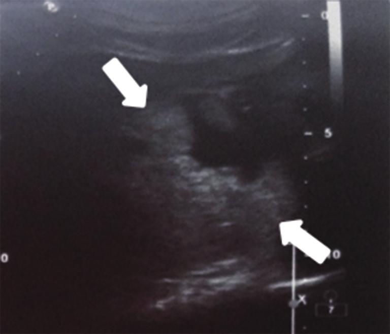 1102 Fu et al. Ultrasound features of IPMN-B A B C D Figure 4 Type IV, aneurismal dilation.