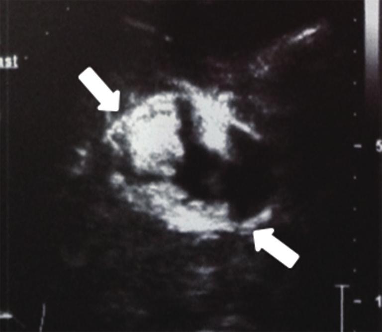 (arrows); (C) the nodular enhancement within the local dilated bile duct (arrows) was shown by contrast-enhanced ultrasound; (D) the pathological results indicated adenocarcinoma in the left liver (