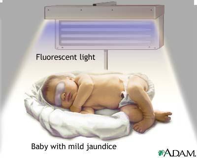 Remember Bili Lights? Using bili lights is a therapeutic procedure performed on newborn or premature infants to reduce elevated levels of bilirubin.