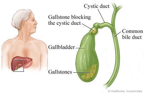 Gallstones (Cholelithiasis) Gallstones are made from cholesterol and other things