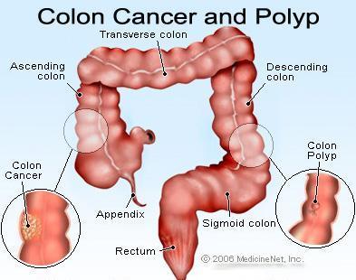 Colon Cancer Colonoscopy is a screening