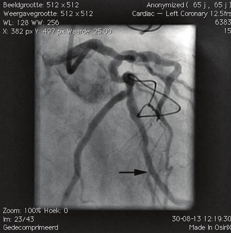 014 guidewire (see Figure II), and the lesion predilated with a 2.0 x 10 mm SapphireTM II Coronary Dilatation Catheter.