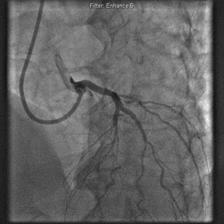 An angiogram performed three months previously for exertional angina demonstrated significant 3 vessel coronary artery disease and a myocardial perfusion scan demonstrated