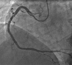 Repeat angiography during this admission confirmed worsening disease in the mid vessel of a dominant right coronary artery (see Figure I) and a severe bifurcation lesion