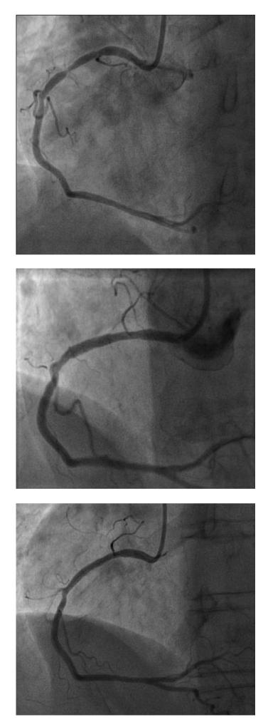 At the referring hospital, angiography was conducted which revealed a severely calcified subtotal stenosis at the proximal RCA and a second lesion at the proximal LAD.