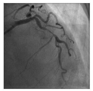 Six months later, the patient was re-admitted with stable angina and angiography confirmed progressive disease in the LAD.
