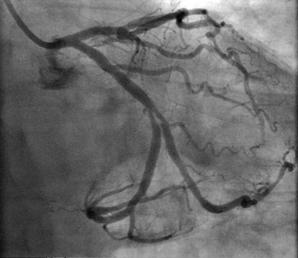 Upon good anchorage of a 6F radial guiding catheter at the left ostium, two guidewires were positioned at the distal OMCx and