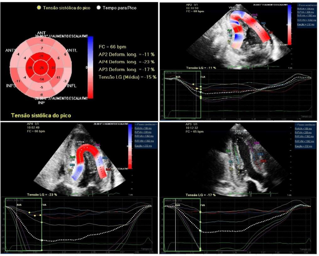 Figure 2 Speckle Tracking Echocardiography of patient with amyloidosis. Videos and complete medical report attached.