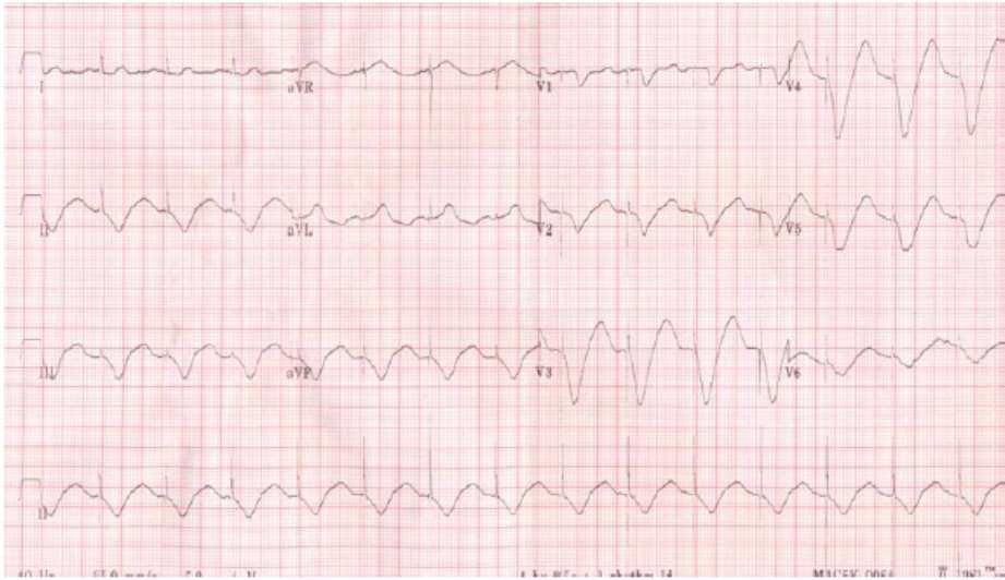 Paced ECG Morphology Reveals More than What It Conceals 79 Fig. 1. ECG at presentation showing that all ventricular beats are paced.