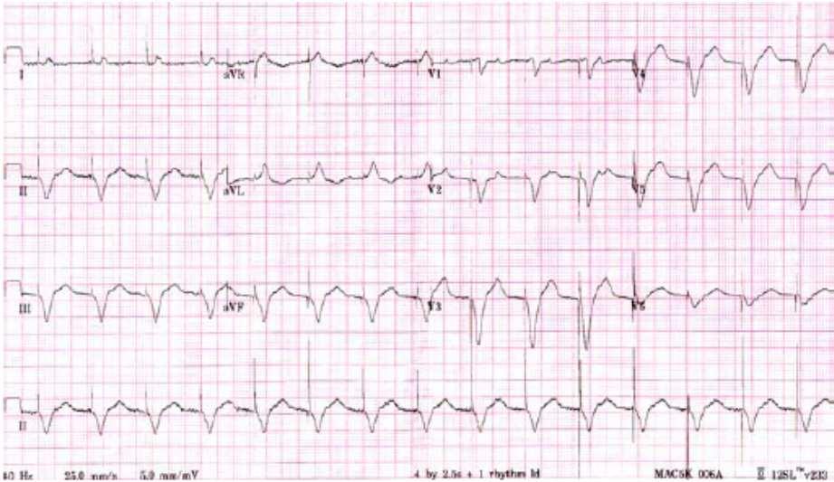 80 Advances in Electrocardiograms Clinical Applications Fig. 2. ECG after correction of hyperkalemia.