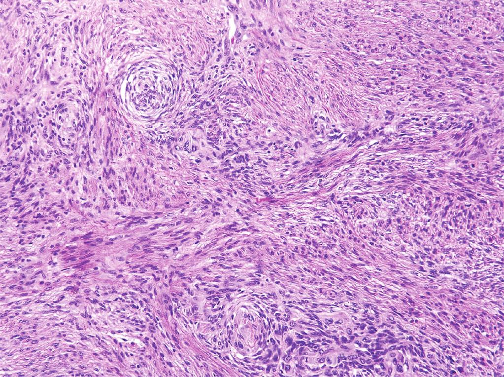 (b) Uterine tumor, low-grade areas reminiscent of leiomyoma (hematoxylin and eosin, original magnification 200).