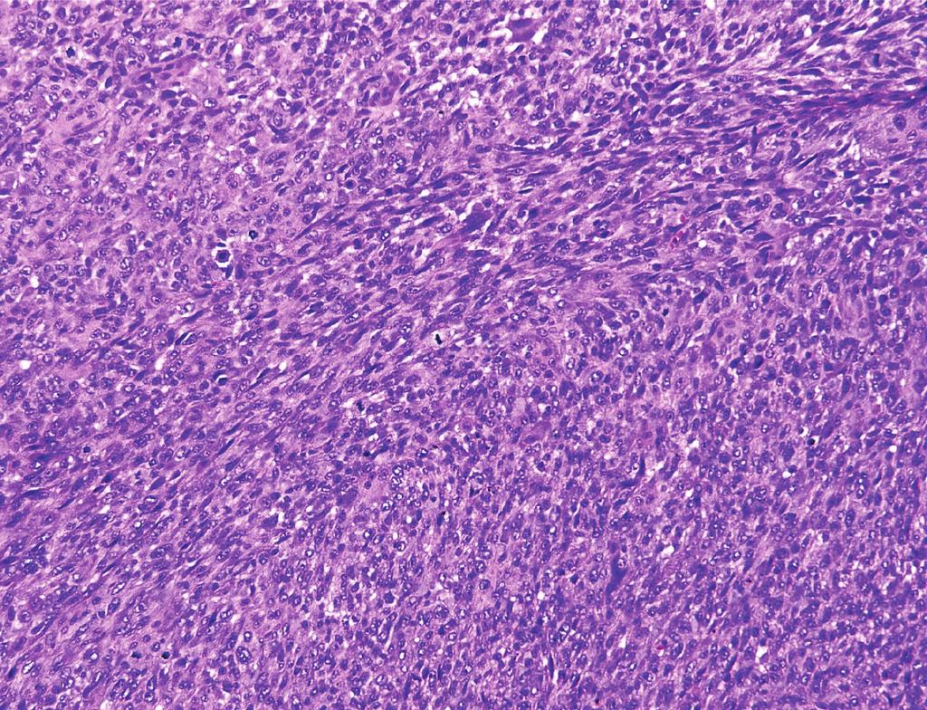 (f) Extrauterine tumor, showing scattered cells with expression of the estrogen receptor (immunoperoxidase, original magnification 200). extrauterine lesions.
