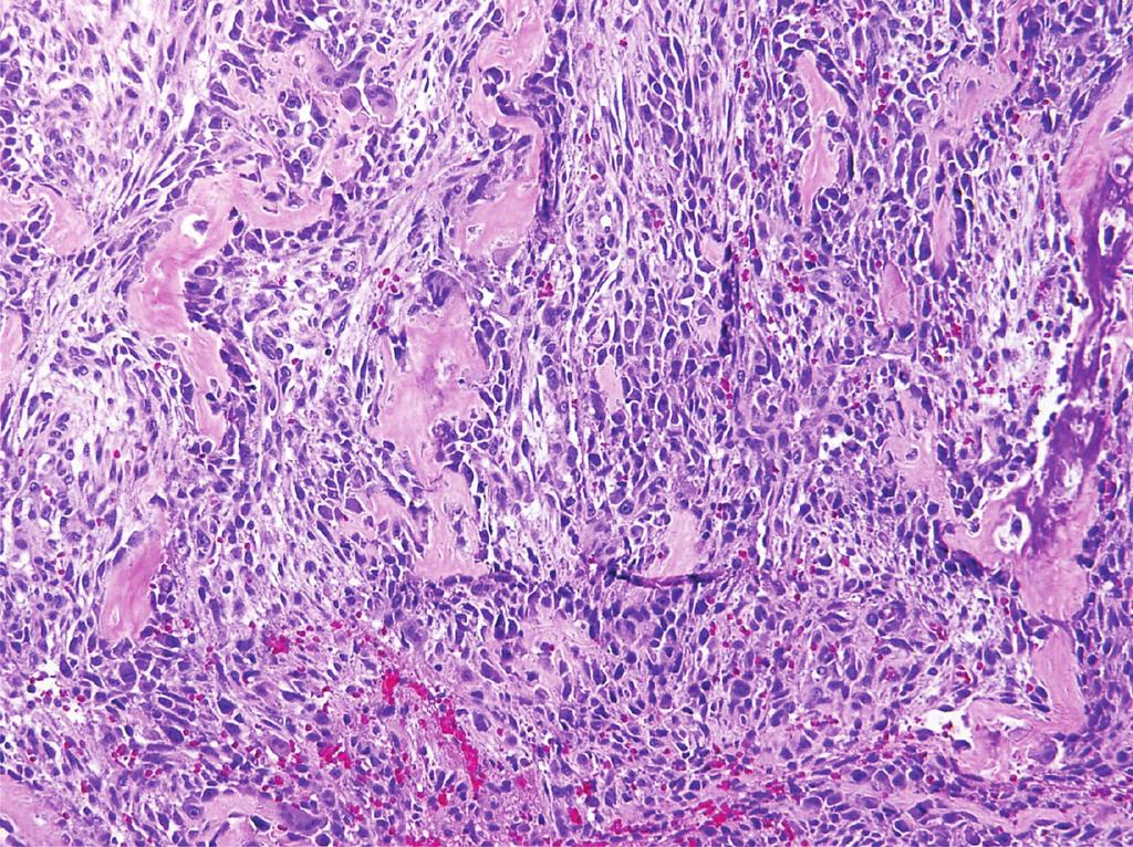 dediﬀerentiated leiomyosarcoma as well as other dediﬀerentiated neoplasms.