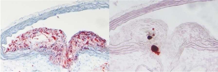2 Atherosclerosis µm 2
