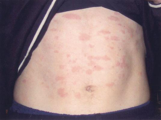 ANAKINRA IN MWS 609 Figure 1. Rash in a 22-year-old man with Muckle-Wells syndrome associated with NALP3 V200M variant.