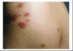 keratosis) Non-acantholytic Viral infections
