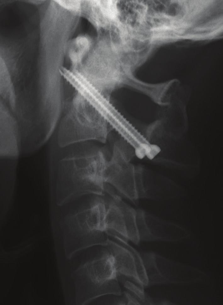 Case Reports in Orthopedics 3 Figure 4: Postoperative cervical spine plain X-ray images. Atlantoaxial subluxation was improved with the adhesion of grafted bone.