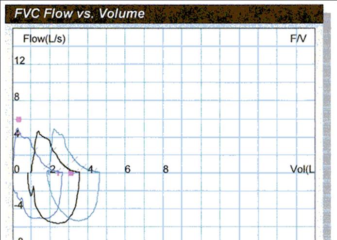 PEF FEF 25% Expiration FEF 75% FVC Volume (L) Inspiration Flow (L per second) Normal Flow Volume Loop (office
