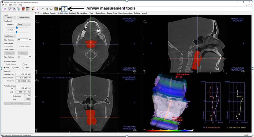 Figure 1 Display of Invivo5 software for airway analysis in section menu. The airway segmenting tools are shown by the arrow. Full-size DOI: 10.7717/peerj.