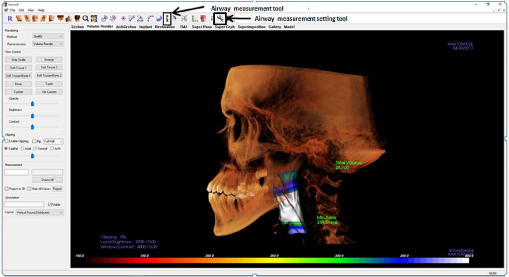 Figure 2 Display of Invivo5 software for airway analysis in volume render menu. The airway segmenting tools are shown by the arrow. Full-size DOI: 10.7717/peerj.6319/fig-2 In Romexis version 3.8.2.R software, the airway was measured using the region growing feature (as in Fig.