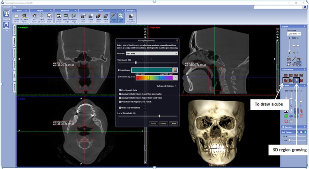 Figure 3 Display of Romexis (version 3.8.2.R) software for airway analysis using region growing tools. The button of to draw a cube and 3D region growing are shown by the arrow. Full-size DOI: 10.
