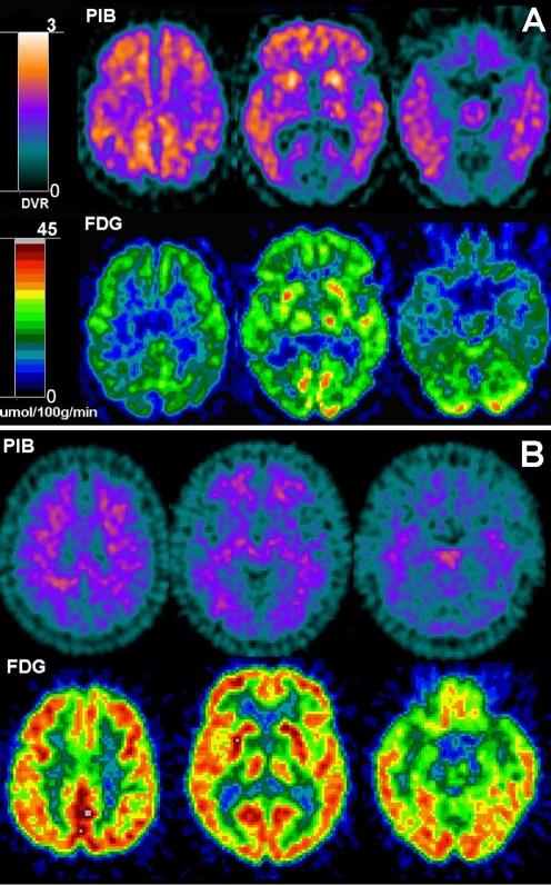 PET Amyloid Imaging Positron Emission Tomography (PET) Fluorodeoxy-glucose (sugar) measures brain activity; decreased with dementia Amyloid tracers