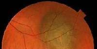 Background More than 90% of intraocular melanomas involve the choroid About 50% cause fatal