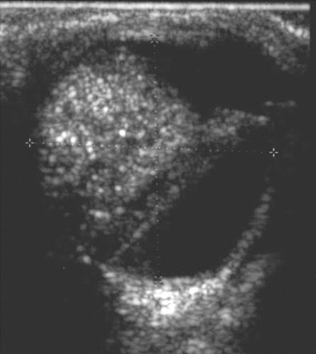 Retinoblastoma Most common pediatric ocular tumor; highly malignant; 1/3 bilateral