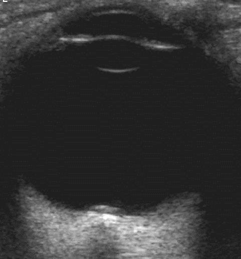 ophthalmoscopic view -> Ultrasound to evaluate for