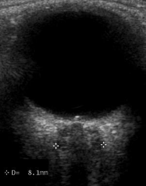 Papilledema Elevation of the optic disk, due to elevated intracranial pressure