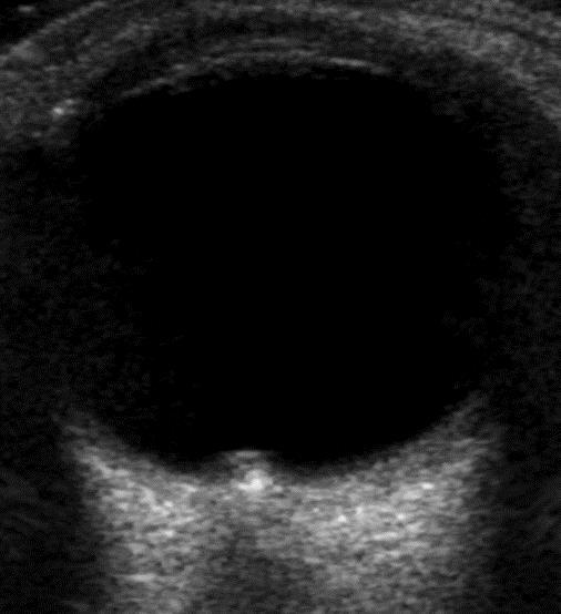 Drusen Benign calcium deposits at optic nerve head Usually bilateral Clinically may be
