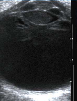 obscures ophthalmoscopic view Ultrasound: strands of