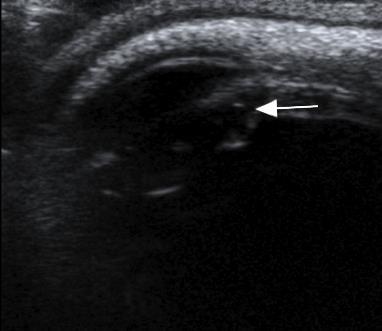 Ciliary Body Cyst Common Most are congenital or from trauma Often too small and seen